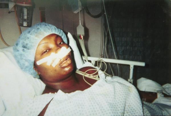 A photo of Natania Reuben in a hospital bed with her face bandaged in 1999.