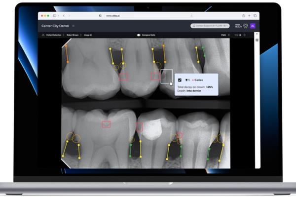 AI allows dentists to be more accurate and lower the error rate when diagnosing patients. 