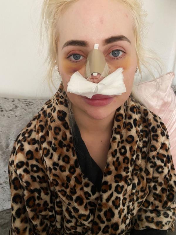 Dolly Simpson, 26, from the UK, following a nose job.