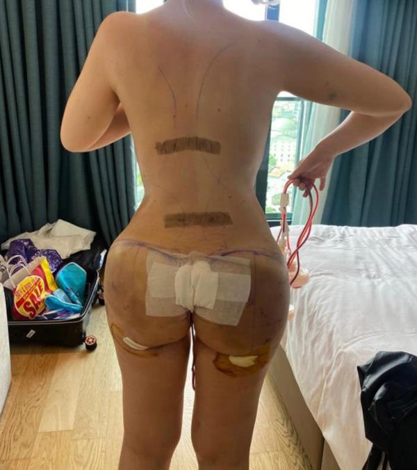 Dolly Simpson, 26, from the UK, after her Brazilian Butt Lift procedure. 