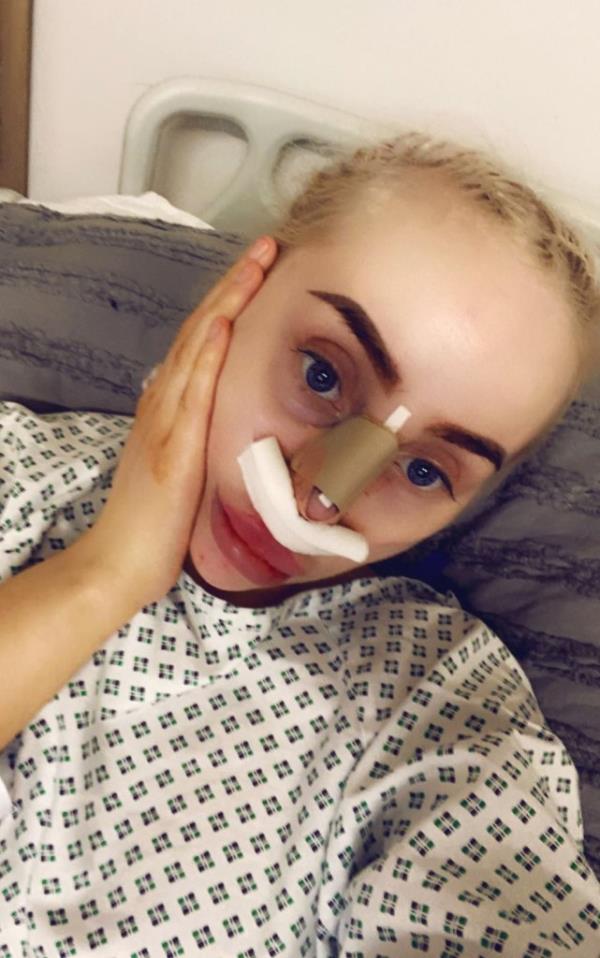 Daisy Simpson, 26, from the UK, following a nose job.